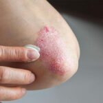 Sedef Hastalığı (Psoriasis) Nedir, Neden Olur,? Belirtileri ve Tedavi Yöntemleri Nelerdir?