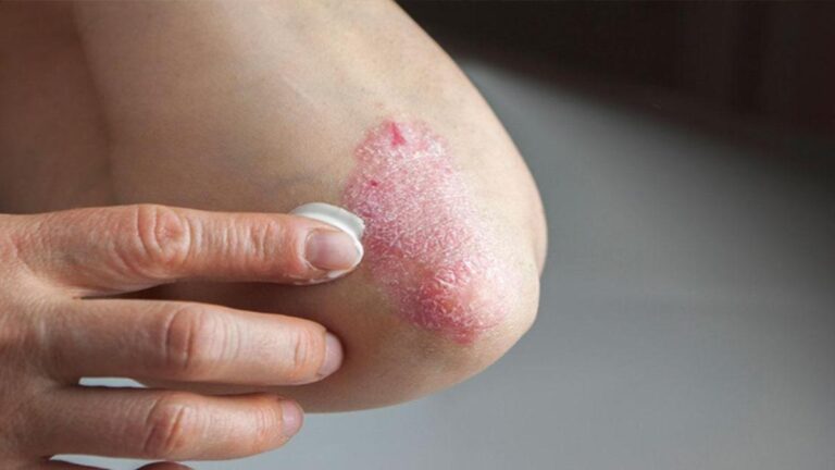 Sedef Hastalığı (Psoriasis) Nedir, Neden Olur,? Belirtileri ve Tedavi Yöntemleri Nelerdir?