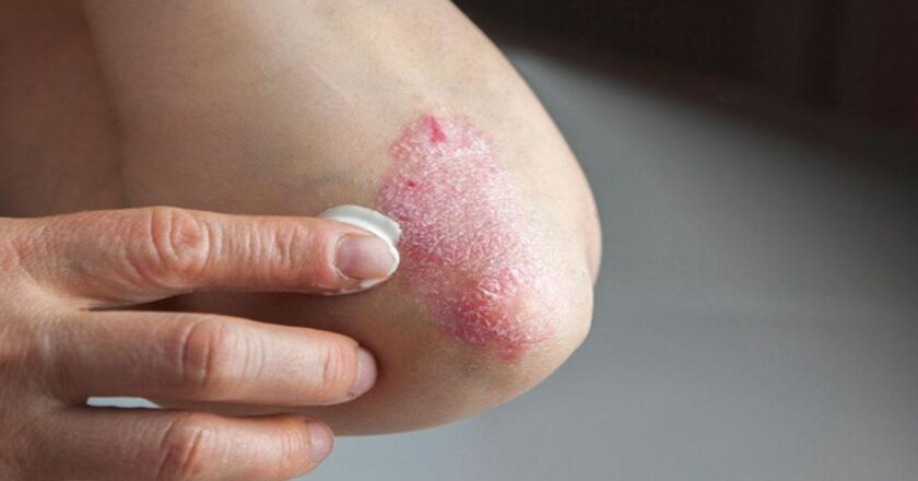 Sedef Hastalığı (Psoriasis) Nedir, Neden Olur,? Belirtileri ve Tedavi Yöntemleri Nelerdir?