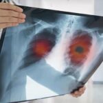 Akciğer Kanseri Geç Belirleniyor: Hastaların %60’ı İleri Evrede Teşhis Ediliyor