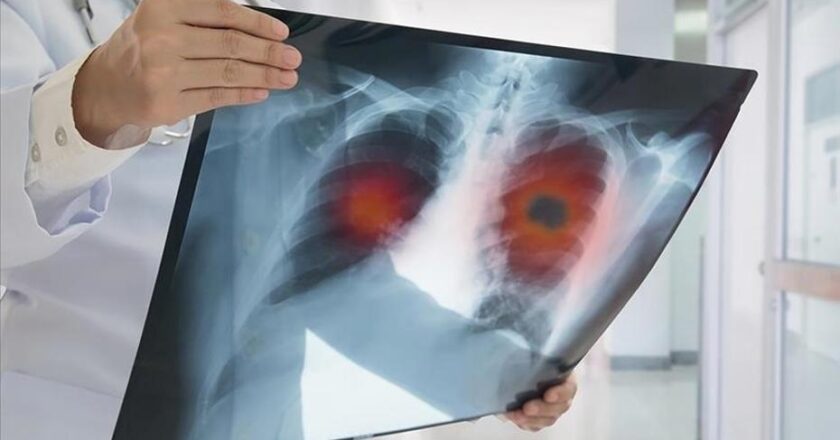 Akciğer Kanseri Geç Belirleniyor: Hastaların %60’ı İleri Evrede Teşhis Ediliyor